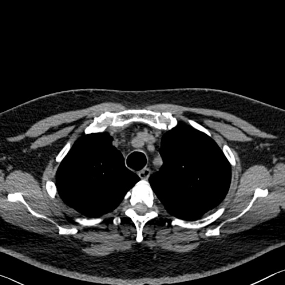 Adenoid cystic carcinoma of the trachea (Radiopaedia 49042-54137 Axial non-contrast 71).jpg