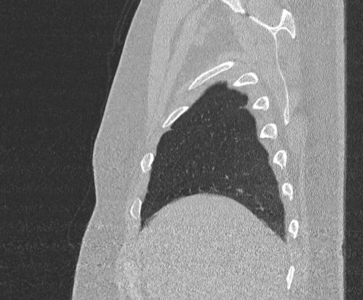 Adenoid cystic carcinoma of the trachea (Radiopaedia 49042-54137 Sagittal lung window 68).jpg