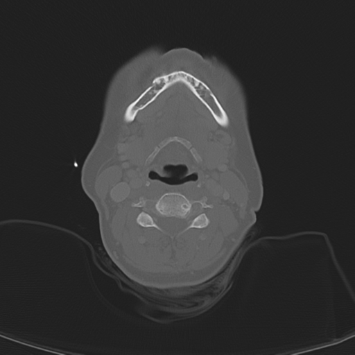 File:Adenoid cystic tumor of palate (Radiopaedia 46980-51518 Axial bone window 43).png