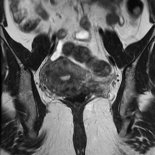 File:Adenoma malignum of cervix (Radiopaedia 66441-75705 Coronal T2 12).jpg
