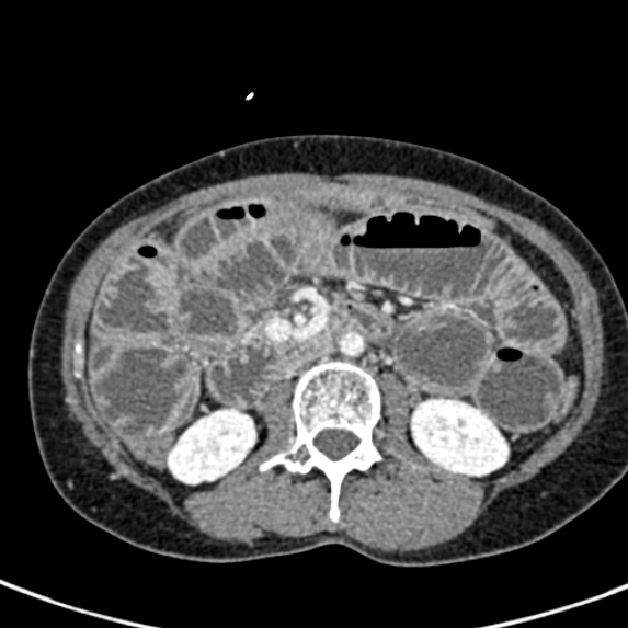 Adhesional small bowel obstruction (Radiopaedia 48397-53305 Axial C+ portal venous phase 35).jpg