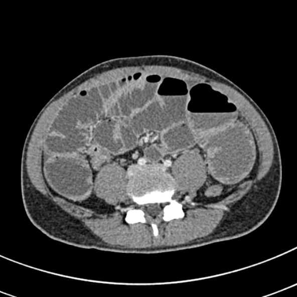 File:Adhesional small bowel obstruction (Radiopaedia 52107-57980 Axial C+ portal venous phase 80).jpg