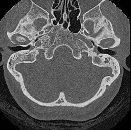 File:Adhesive chronic otitis media (Radiopaedia 14270-14148 Axial bone window 13).jpg
