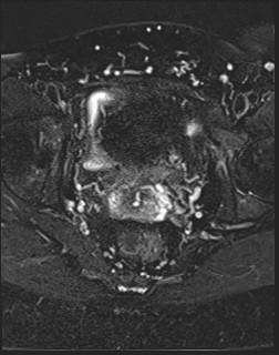 File:Adnexal multilocular cyst (O-RADS US 3- O-RADS MRI 3) (Radiopaedia 87426-103754 Axial T2 fat sat 17).jpg
