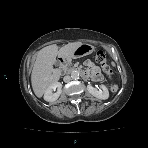 File:Adrenal collision tumor (ACT) (Radiopaedia 48462-53379 Axial C+ delayed 26).jpg
