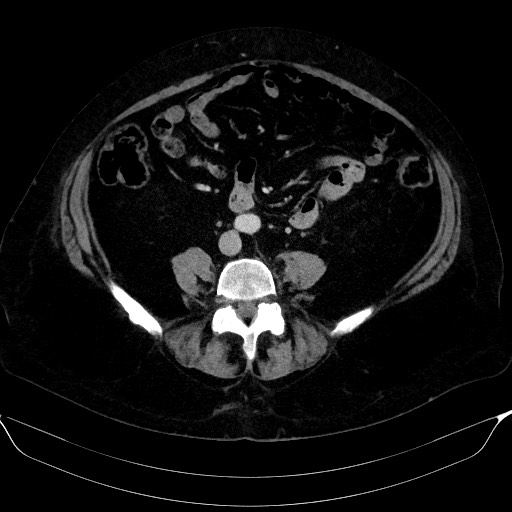 Adrenal cortical carcinoma (Radiopaedia 64017-72769 Axial C+ portal venous phase 44).jpg