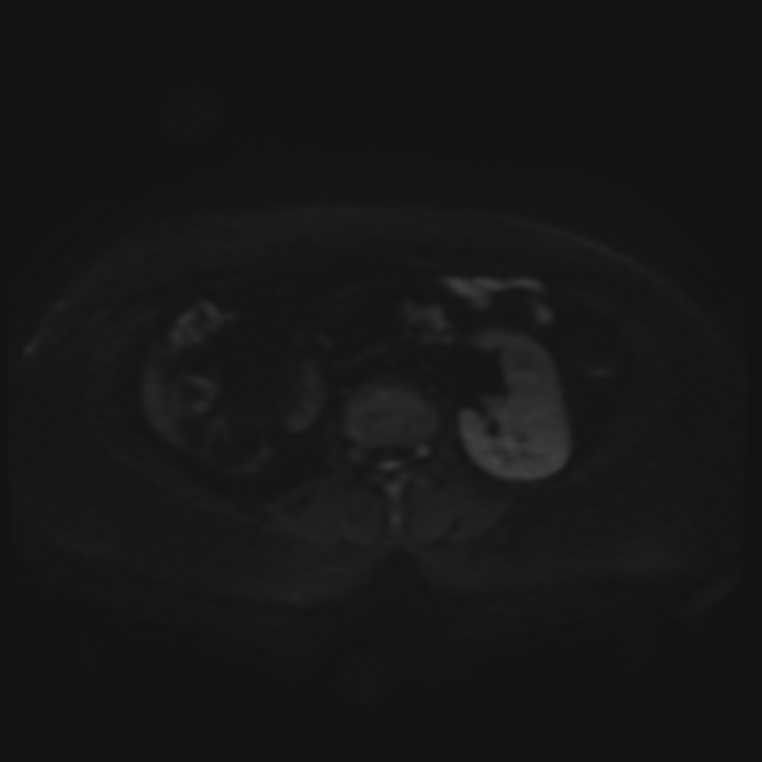 Adrenal cortical carcinoma (Radiopaedia 70906-81116 Axial DWI 49).jpg