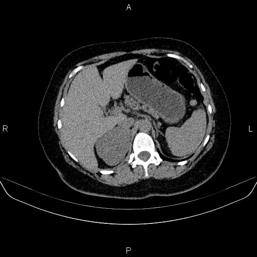 File:Adrenal cortical carcinoma (Radiopaedia 84882-100379 Axial non-contrast 24).jpg