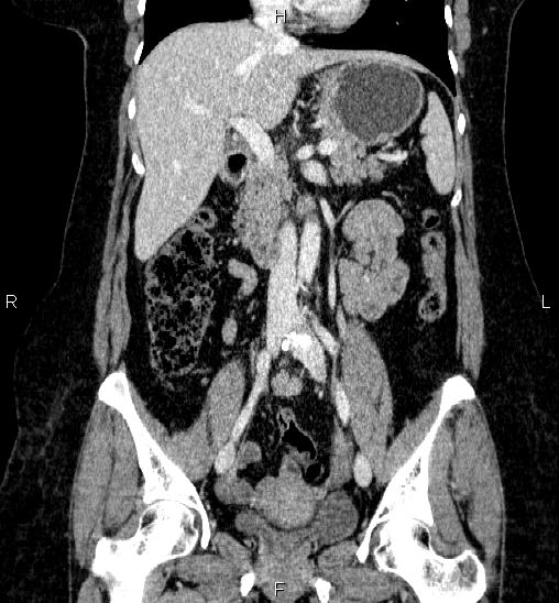 Adrenal cortical carcinoma (Radiopaedia 84882-100379 Coronal C+ portal venous phase 31).jpg
