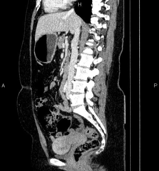 Adrenal cortical carcinoma (Radiopaedia 84882-100379 Sagittal C+ portal venous phase 44).jpg