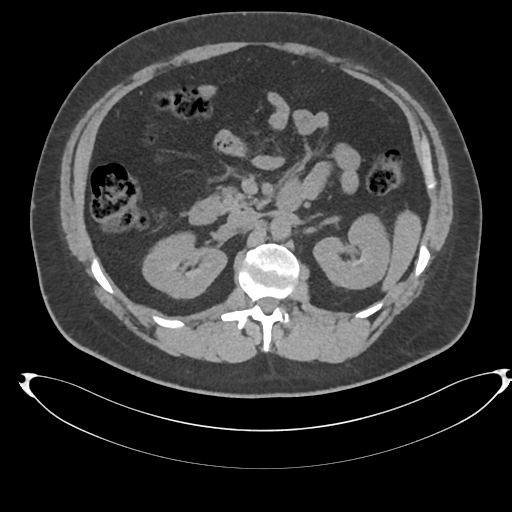 Adrenal cyst (Radiopaedia 45625-49778 Axial non-contrast 44).png