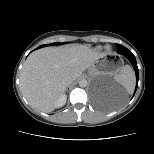 File:Adrenal cyst (Radiopaedia 64869-73813 Axial C+ portal venous phase 17).jpg
