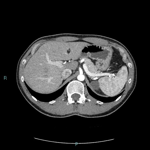 File:Adrenal cystic lymphangioma (Radiopaedia 83161-97534 Axial C+ arterial phase 26).jpg