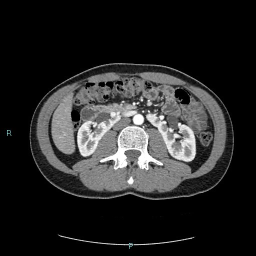 Adrenal cystic lymphangioma (Radiopaedia 83161-97534 Axial C+ arterial phase 45).jpg