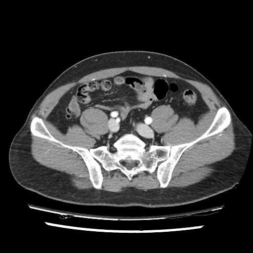 File:Adrenal gland trauma (Radiopaedia 81351-95078 Axial Dual bolus trauma C+ 99).jpg