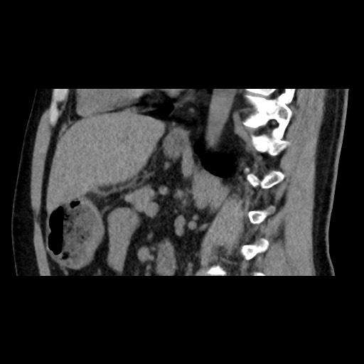 File:Adrenal gland trauma (Radiopaedia 81351-95079 Sagittal non-contrast 58).jpg