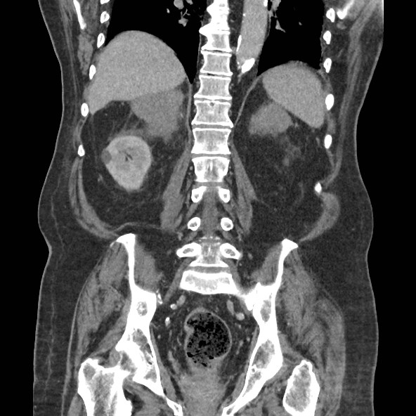 Adrenal lymphoma (Radiopaedia 84145-99415 Coronal C+ portal venous phase 63).jpg