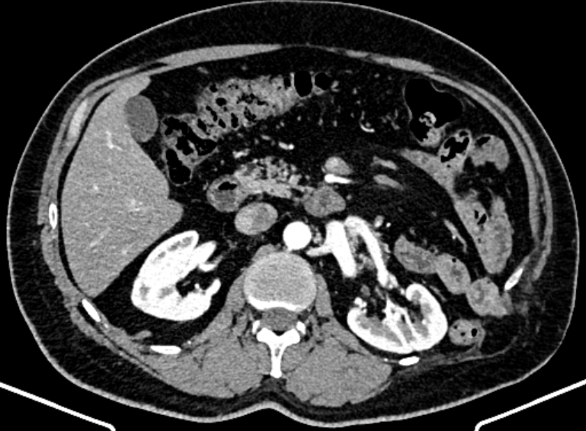 Adrenal metastases (Radiopaedia 73082-83791 Axial C+ arterial phase 71).jpg