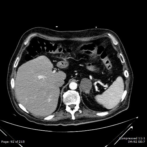 Adrenal metastasis (Radiopaedia 78425-91079 Axial C+ arterial phase 22).jpg