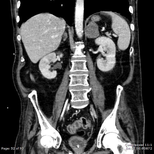Adrenal metastasis (Radiopaedia 78425-91079 Sagittal C+ portal venous phase 39).jpg