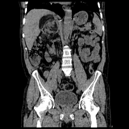 File:Adrenal myelolipoma (Radiopaedia 41843-44834 Coronal non-contrast 6).jpg