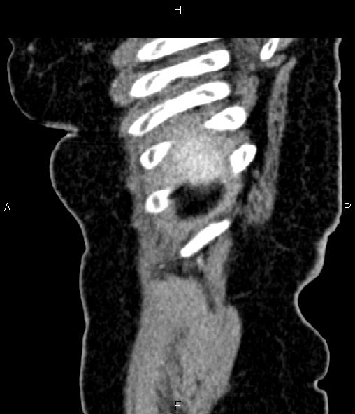 Adrenal myelolipoma (Radiopaedia 82742-96986 Sagittal renal cortical phase 15).jpg