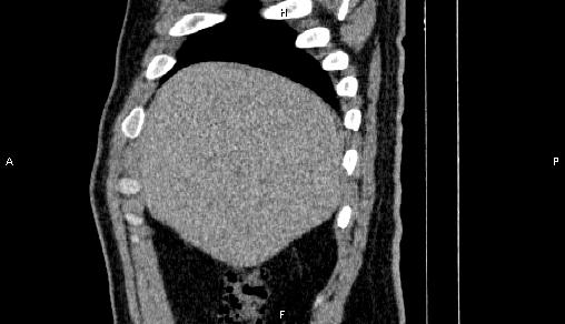 File:Adrenal myelolipoma (Radiopaedia 84321-99619 Sagittal non-contrast 15).jpg