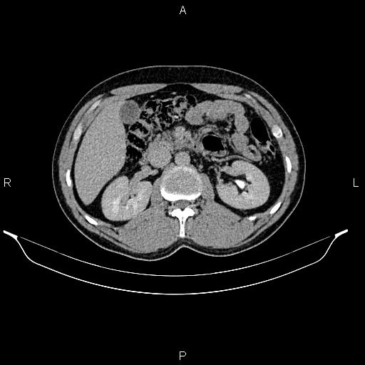 Adrenal myelolipoma (Radiopaedia 87794-104246 Axial renal excretory phase 39).jpg