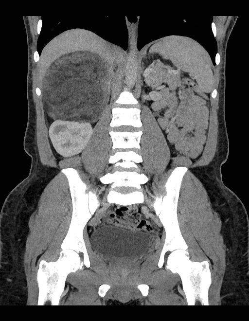 Adrenal myelolipoma - bilateral (Radiopaedia 74805-85810 Coronal C+ portal venous phase 132).jpg
