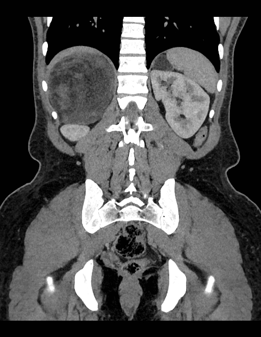 Adrenal myelolipoma - bilateral (Radiopaedia 74805-85810 Coronal C+ portal venous phase 99).jpg