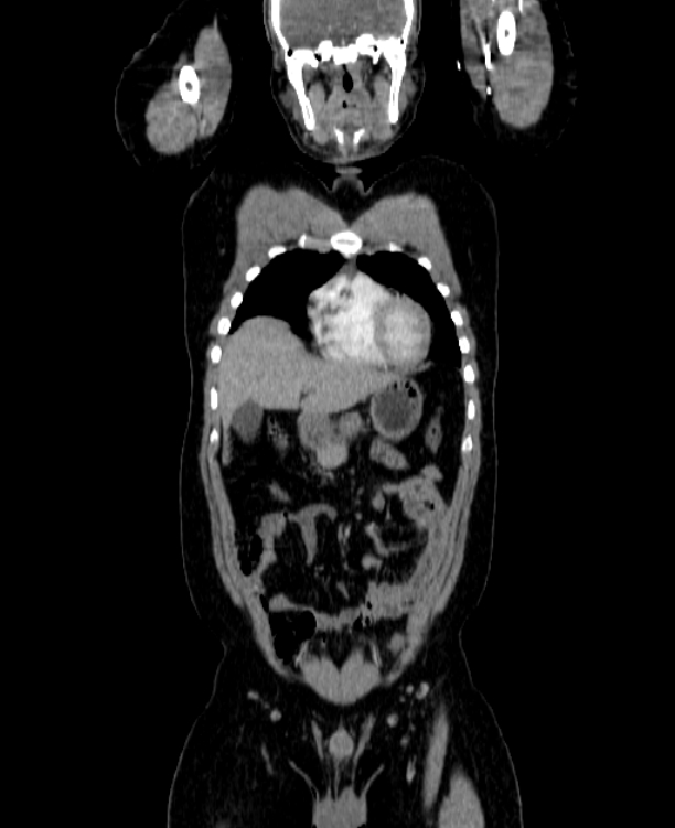 Adrenocortical carcinoma (Radiopaedia 80134-93438 Coronal C+ portal venous phase 47).jpg