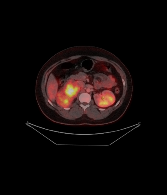 Adrenocortical carcinoma (Radiopaedia 80134-93440 ِAxial 173).jpg