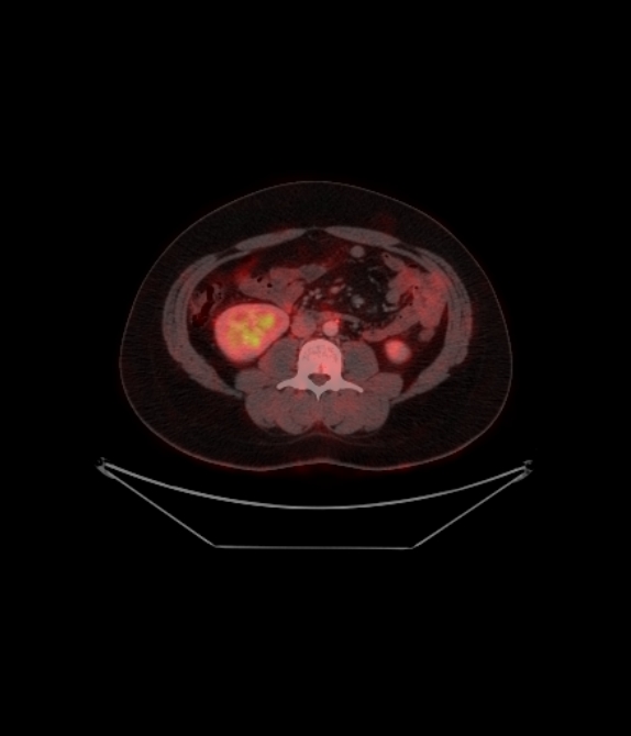 Adrenocortical carcinoma (Radiopaedia 80134-93440 ِAxial 190).jpg