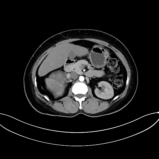 Adrenocortical carcinoma (Radiopaedia 87281-103569 Axial C+ arterial phase 36).jpg