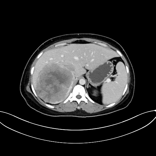 File:Adrenocortical carcinoma (Radiopaedia 87281-103569 Axial C+ portal venous phase 23).jpg