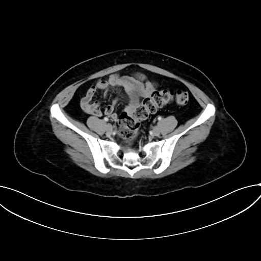 Adrenocortical carcinoma (Radiopaedia 87281-103569 Axial C+ portal venous phase 66).jpg