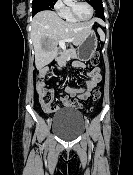 Adrenocortical carcinoma (Radiopaedia 87281-103569 Coronal C+ portal venous phase 9).jpg
