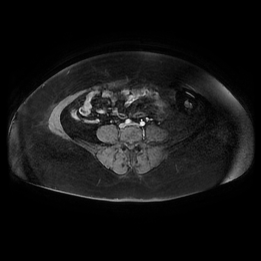 File:Adult granulosa cell tumor of the ovary (Radiopaedia 64991-73953 axial-T1 Fat sat post-contrast dynamic 57).jpg