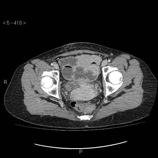 Adult transient intestinal intussusception (Radiopaedia 34853-36310 Axial C+ portal venous phase 110).jpg