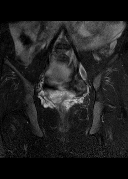 File:Aggressive angiomyxoma of the pelvis and perineum (Radiopaedia 59162-66479 Coronal T2 fat sat 17).jpg