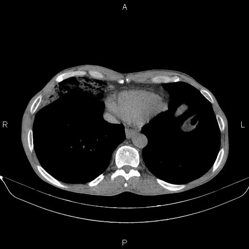 Air bronchogram in pneumonia (Radiopaedia 85719-101512 Axial non-contrast 52).jpg