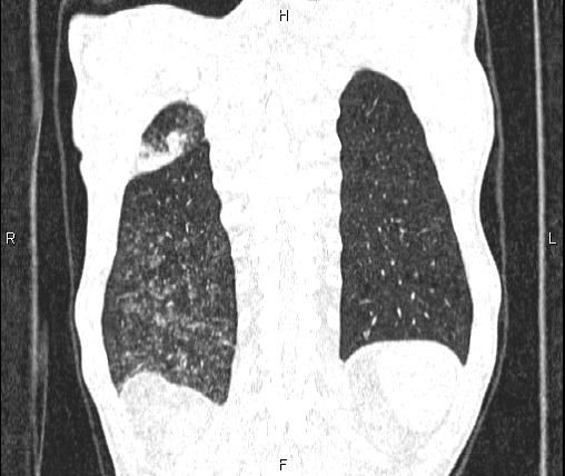 Air bronchogram in pneumonia (Radiopaedia 85719-101512 Coronal lung window 52).jpg