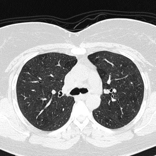 Air trapping in small airway disease (Radiopaedia 61685-69694 Axial lung window 59).jpg