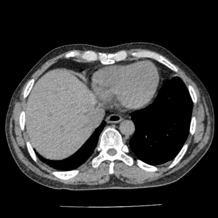 Airway foreign body in adult (Radiopaedia 85907-101779 Axial liver window 148).jpg