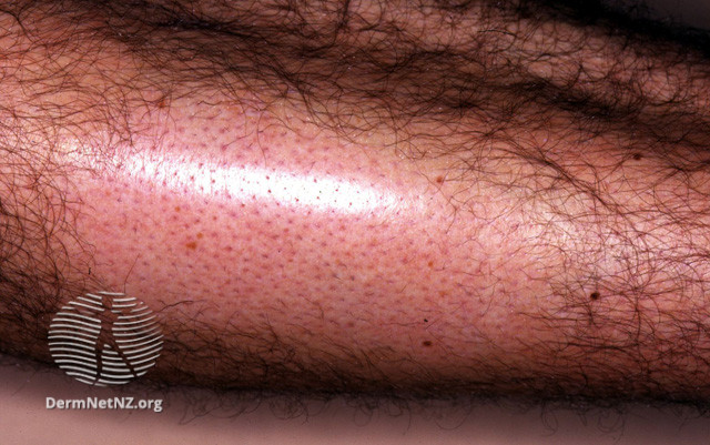 File:Alopecia mucinosa (DermNet NZ hair-nails-sweat-alop-mucin2).jpg