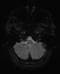File:Alzheimer's disease- with Gerstmann syndrome and dressing apraxia (Radiopaedia 54882-61150 Axial SWI 4).png