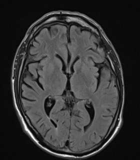 File:Alzheimer's disease- with apraxia (Radiopaedia 54763-61011 Axial FLAIR 14).png