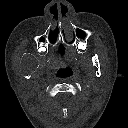 File:Ameloblastoma (Radiopaedia 26645-26793 E 74).jpg