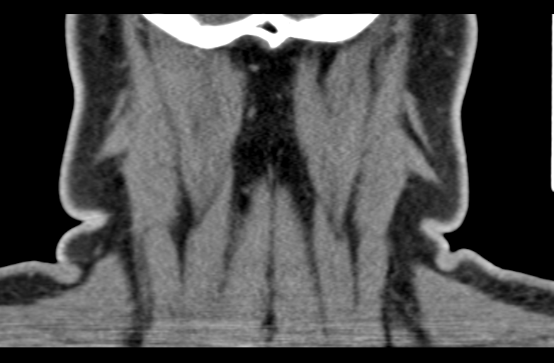 Ameloblastoma (Radiopaedia 33677-34806 Coronal non-contrast 64).png