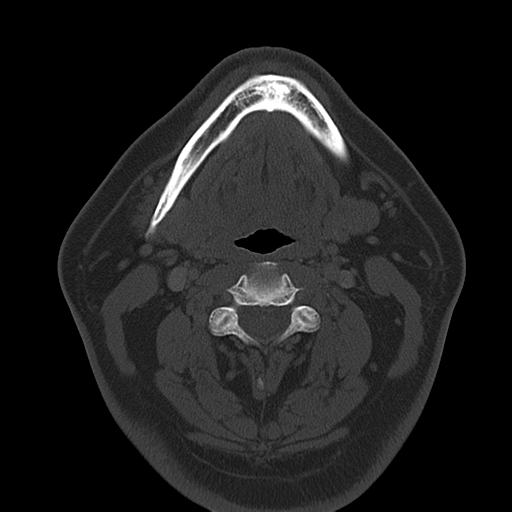 Ameloblastoma (Radiopaedia 38520-40623 Axial bone window 36).png